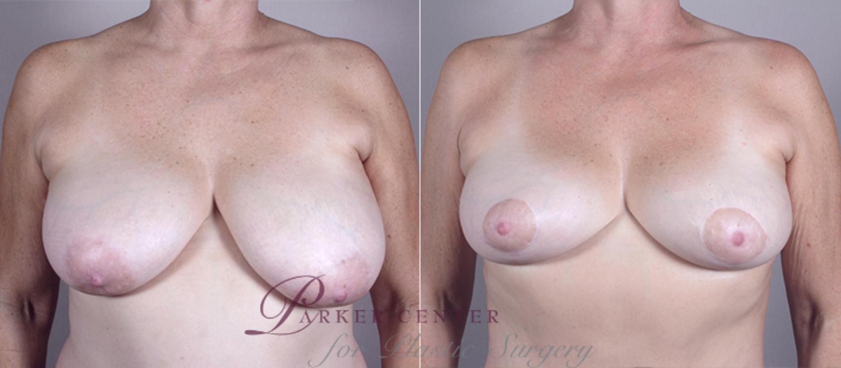 Breast Lift Case 511 Before & After View #1 | Paramus, NJ | Parker Center for Plastic Surgery