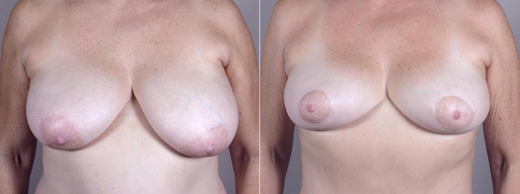 Breast Lift Case 511 Before & After View #1 | Paramus, NJ | Parker Center for Plastic Surgery