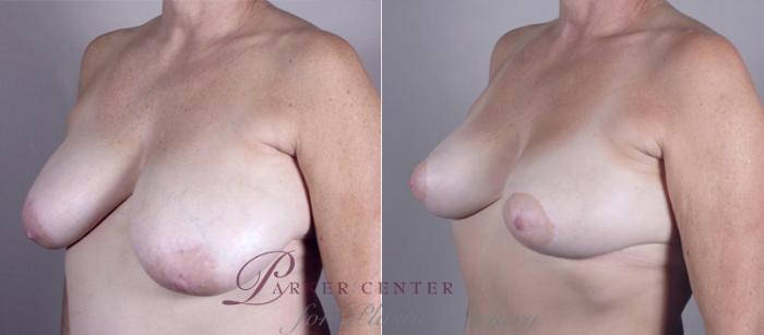 Breast Asymmetry Case 511 Before & After View #2 | Paramus, NJ | Parker Center for Plastic Surgery