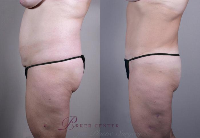 Breast Asymmetry Case 511 Before & After View #4 | Paramus, NJ | Parker Center for Plastic Surgery