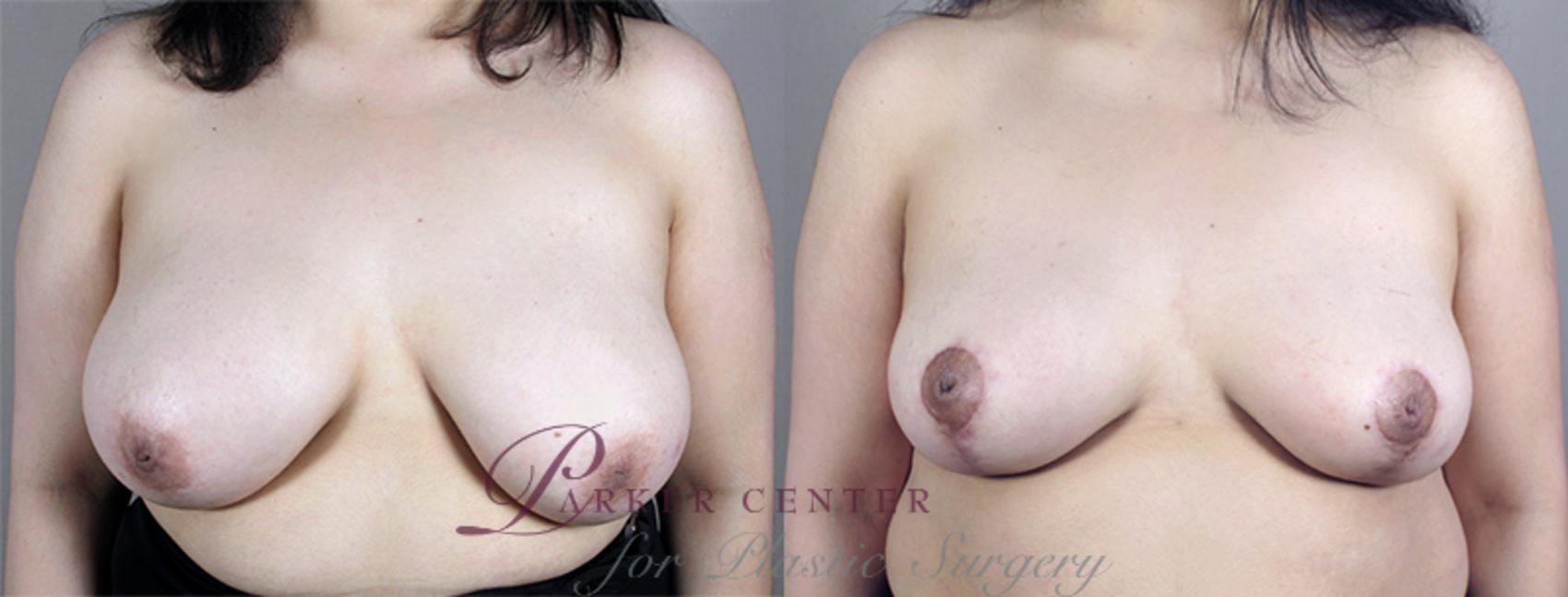 Breast Asymmetry Case 512 Before & After View #1 | Paramus, NJ | Parker Center for Plastic Surgery