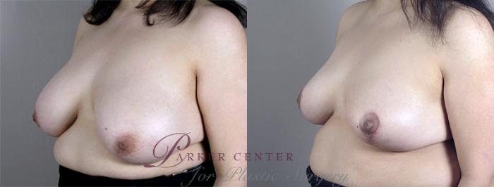 Breast Asymmetry Case 512 Before & After View #2 | Paramus, NJ | Parker Center for Plastic Surgery