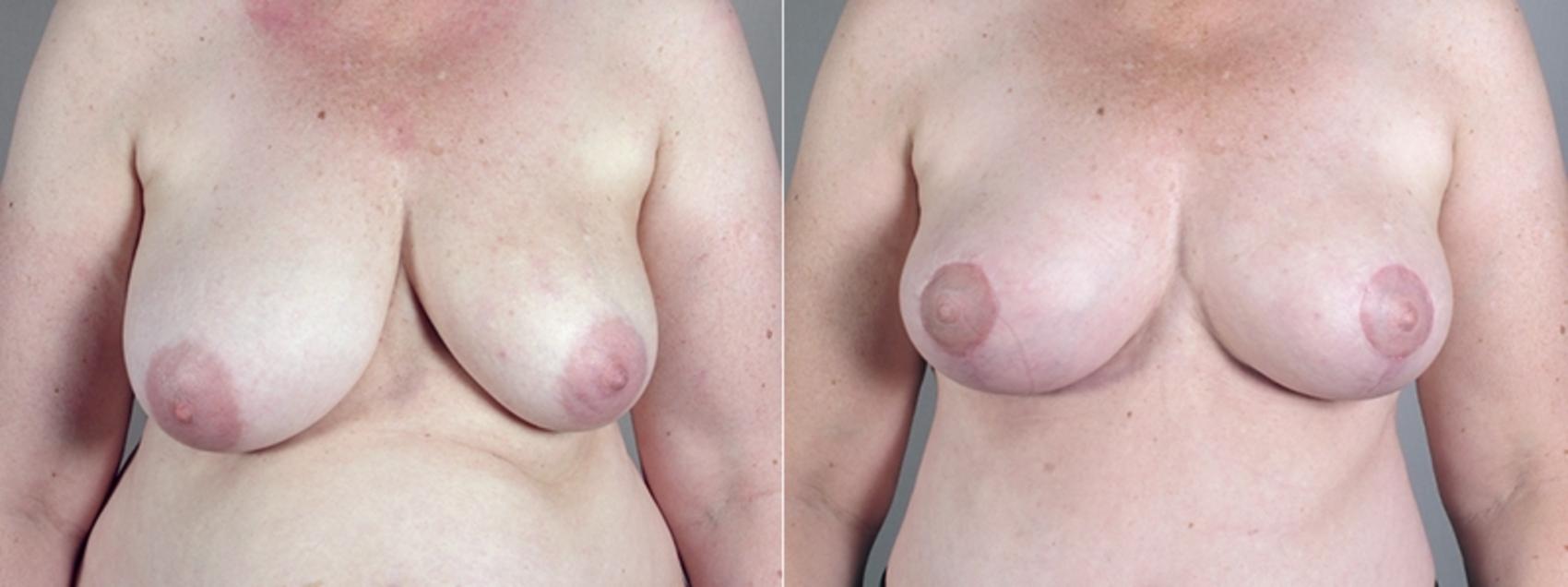 Breast Asymmetry Case 513 Before & After View #1 | Paramus, New Jersey | Parker Center for Plastic Surgery