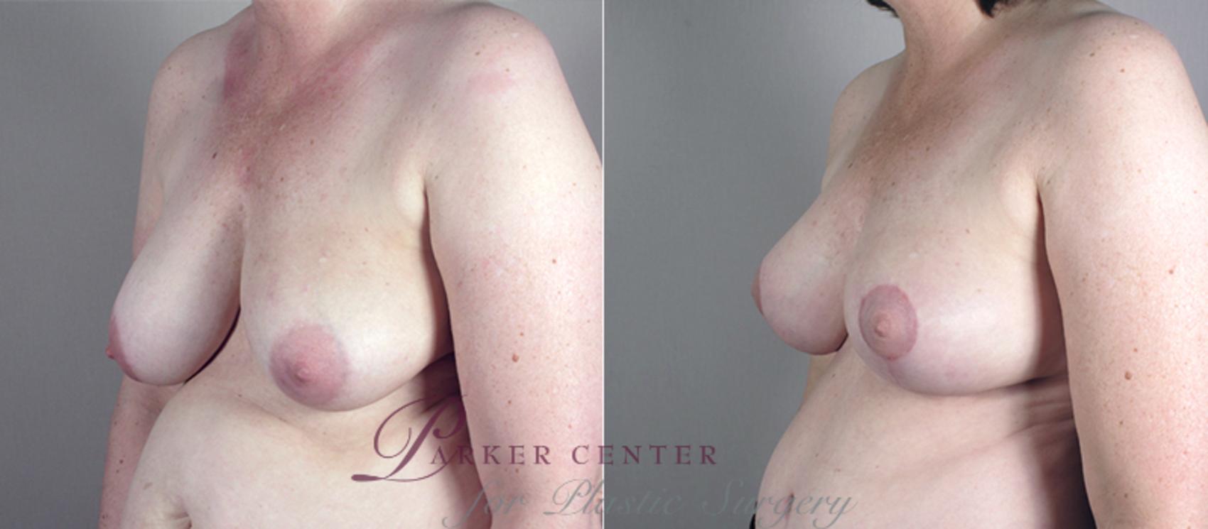 Breast Asymmetry Case 513 Before & After View #2 | Paramus, NJ | Parker Center for Plastic Surgery