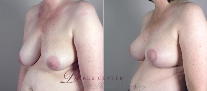 Mommy Makeover Case 513 Before & After View #2 | Paramus, NJ | Parker Center for Plastic Surgery