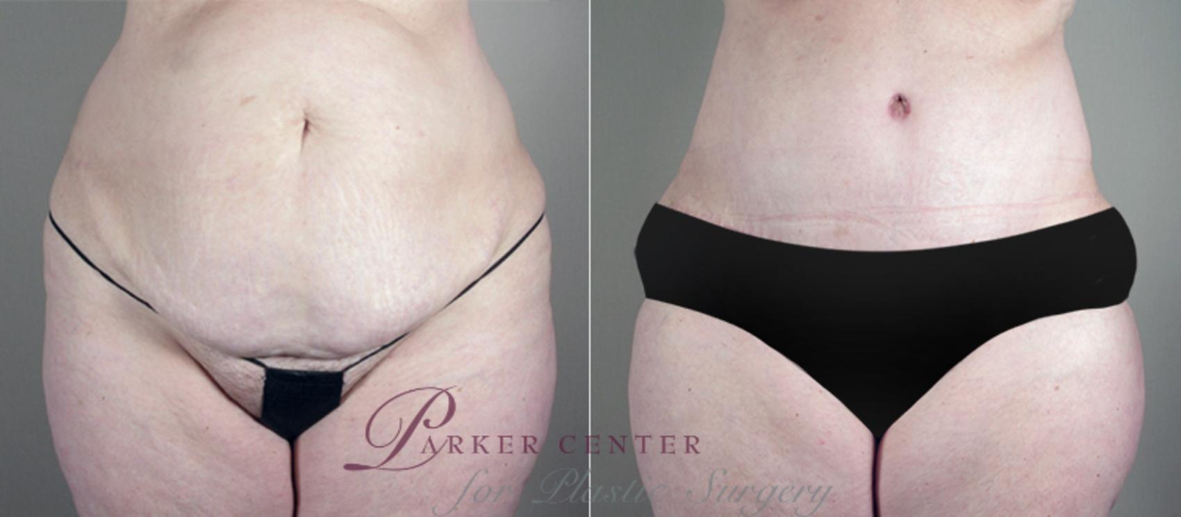Breast Asymmetry Case 513 Before & After View #3 | Paramus, NJ | Parker Center for Plastic Surgery