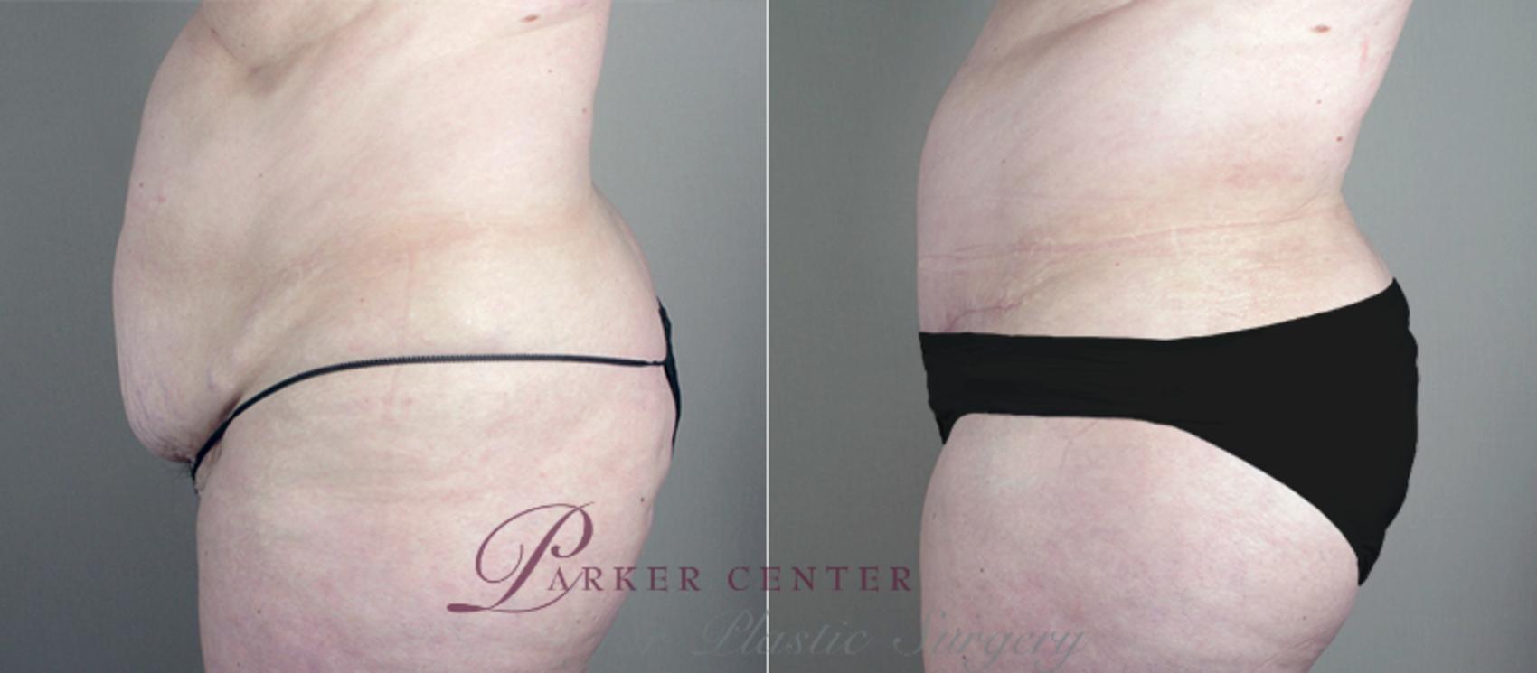 Breast Asymmetry Case 513 Before & After View #4 | Paramus, NJ | Parker Center for Plastic Surgery