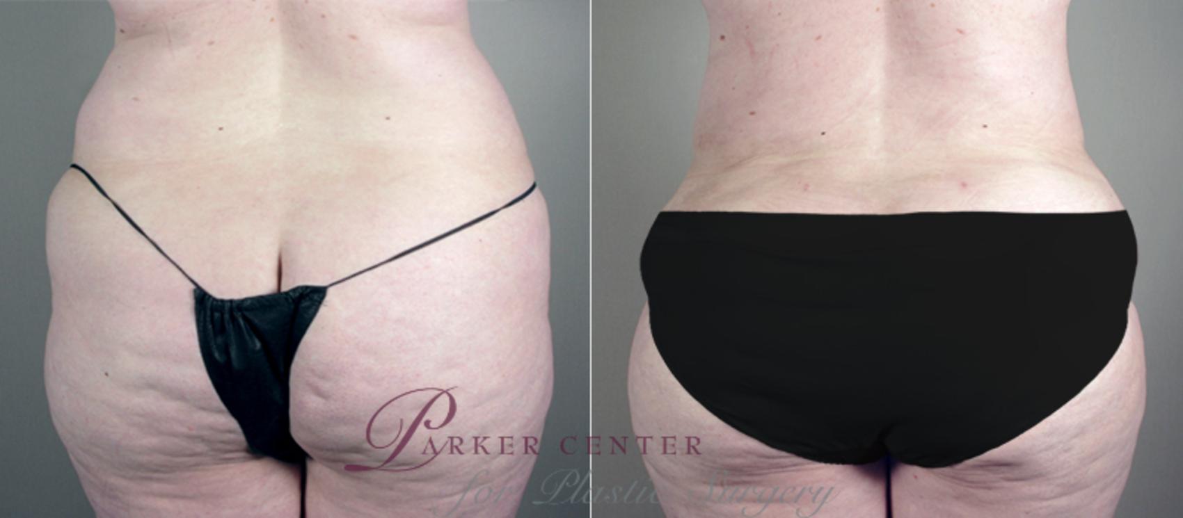 Breast Asymmetry Case 513 Before & After View #5 | Paramus, NJ | Parker Center for Plastic Surgery