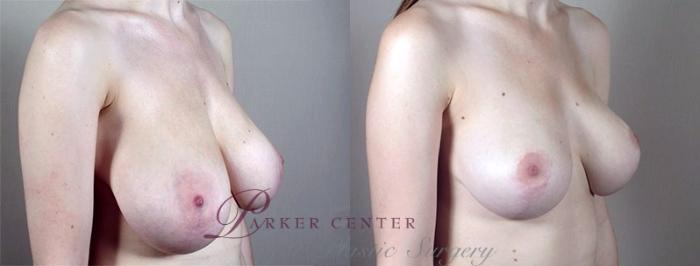 Breast Asymmetry Case 515 Before & After View #1 | Paramus, NJ | Parker Center for Plastic Surgery