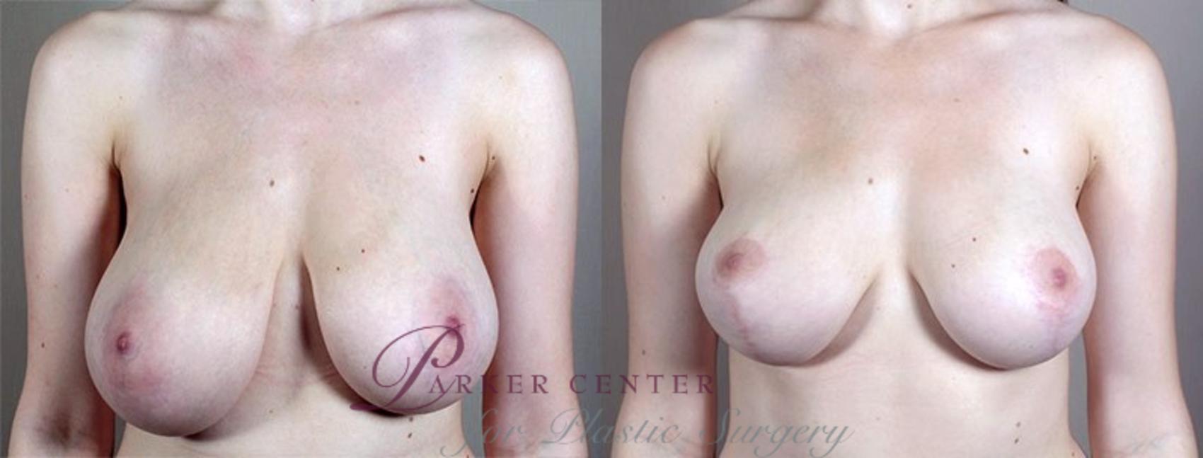Breast Asymmetry Case 515 Before & After View #2 | Paramus, NJ | Parker Center for Plastic Surgery