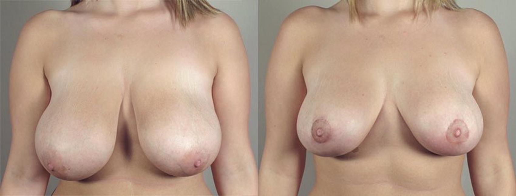 Breast Lift with Auto Aug Case 516 Before & After View #1 | Paramus, NJ | Parker Center for Plastic Surgery