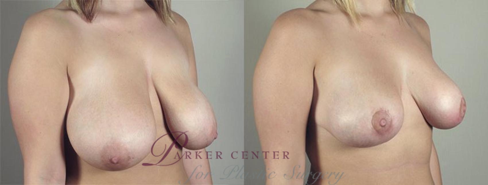 Breast Lift with Auto Aug Case 516 Before & After View #2 | Paramus, NJ | Parker Center for Plastic Surgery
