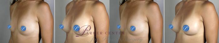 Breast Asymmetry Case 901 Before & After View #4 | Paramus, NJ | Parker Center for Plastic Surgery