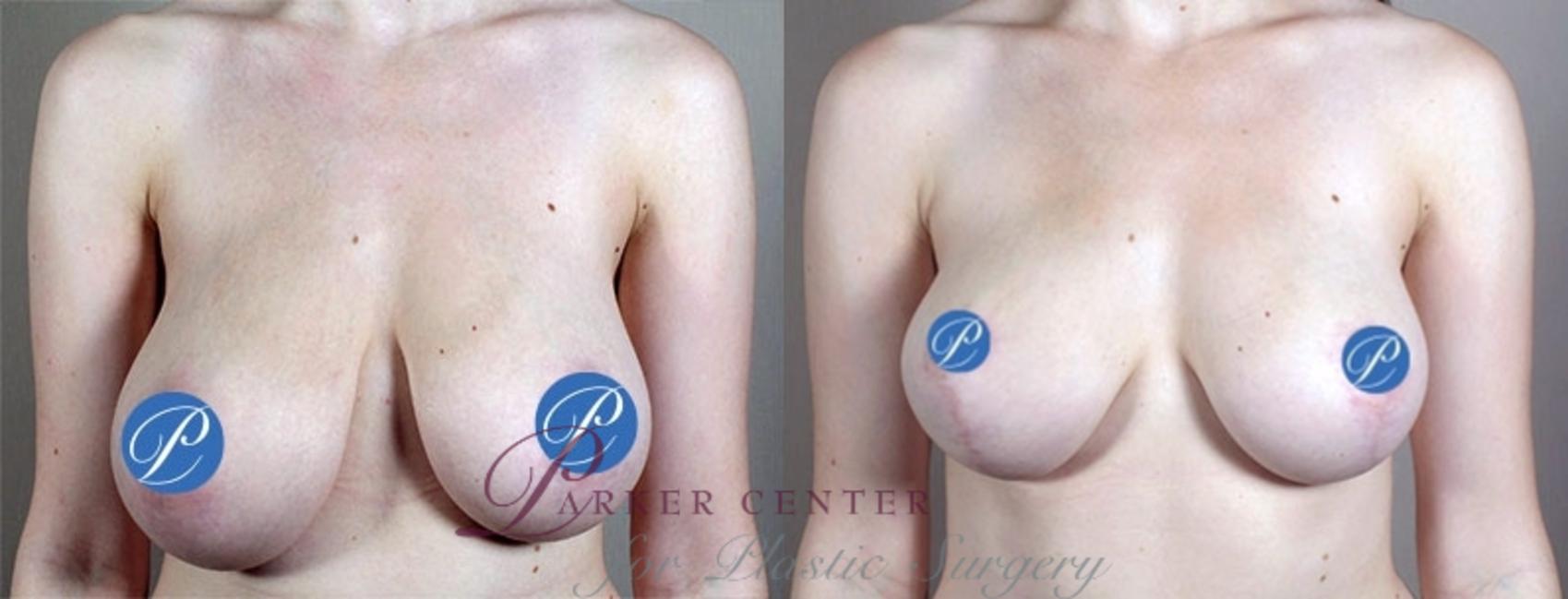 Breast Asymmetry Case 903 Before & After View #5 | Paramus, NJ | Parker Center for Plastic Surgery