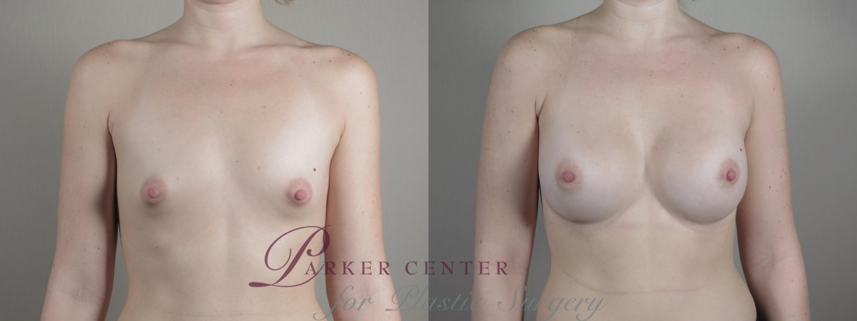 Breast Augmentation Case 1000 Before & After Front | Paramus, NJ | Parker Center for Plastic Surgery