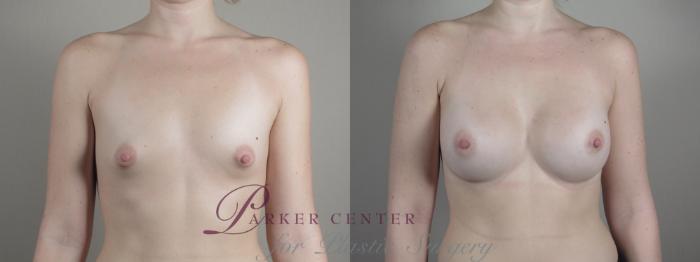 Breast Augmentation Case 1000 Before & After Front | Paramus, NJ | Parker Center for Plastic Surgery