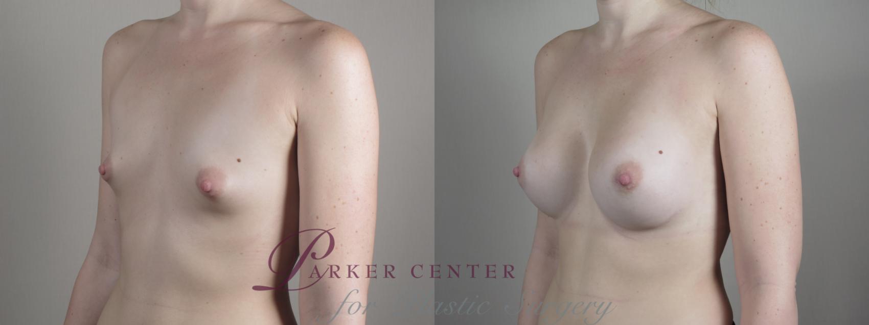 Breast Augmentation Case 1000 Before & After Right Oblique | Paramus, New Jersey | Parker Center for Plastic Surgery