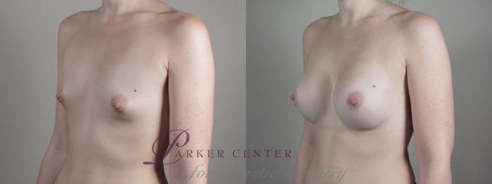Breast Augmentation Case 1000 Before & After Right Oblique | Paramus, NJ | Parker Center for Plastic Surgery