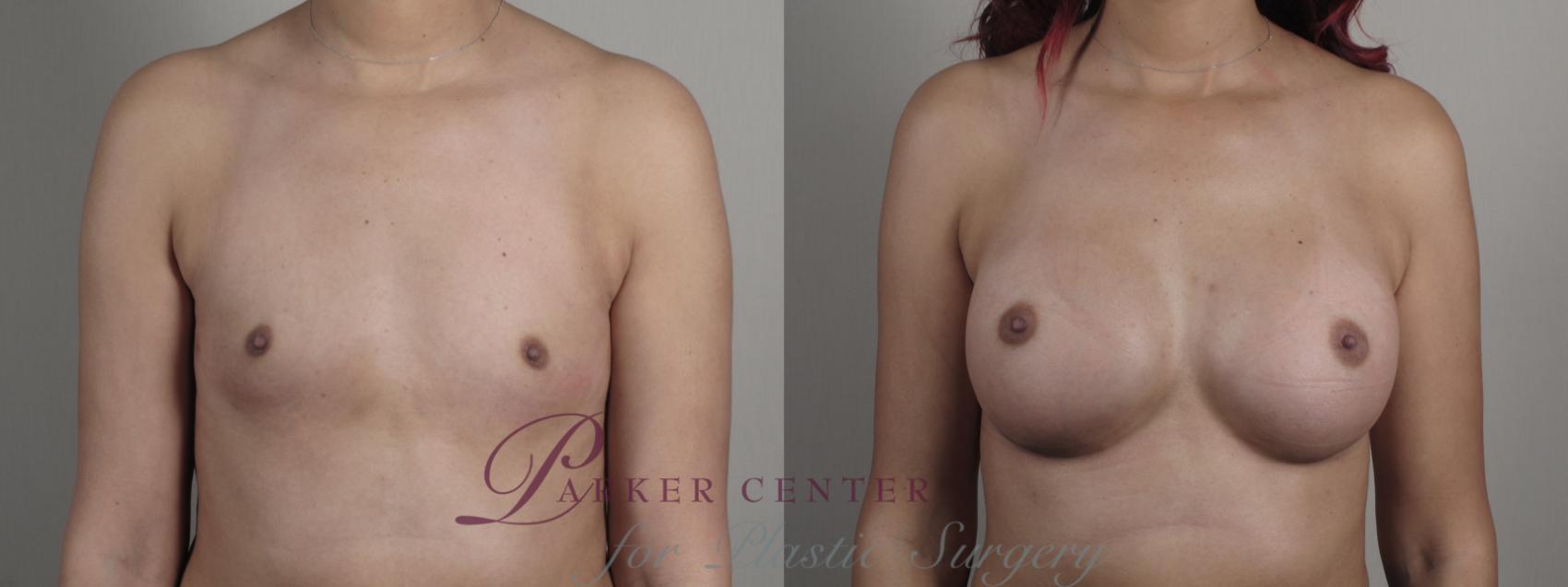 Breast Augmentation Case 1001 Before & After Front | Paramus, NJ | Parker Center for Plastic Surgery