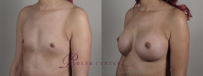Breast Augmentation Case 1001 Before & After Right Oblique | Paramus, NJ | Parker Center for Plastic Surgery