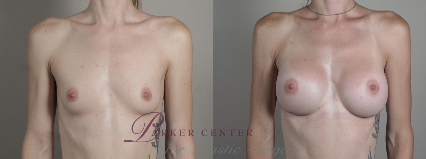 Breast Augmentation Case 1002 Before & After Front | Paramus, NJ | Parker Center for Plastic Surgery