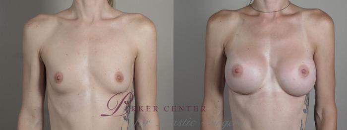 Breast Augmentation Case 1002 Before & After Front | Paramus, NJ | Parker Center for Plastic Surgery
