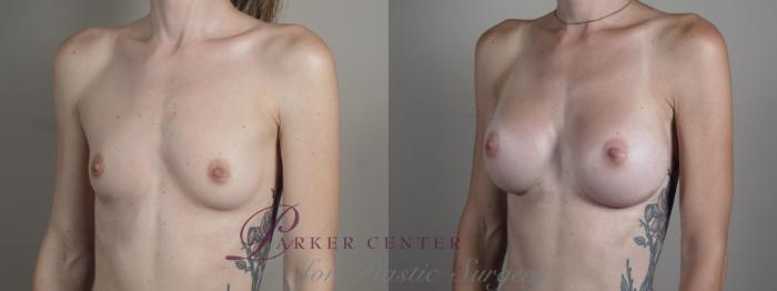 Breast Augmentation Case 1002 Before & After Right Oblique | Paramus, NJ | Parker Center for Plastic Surgery
