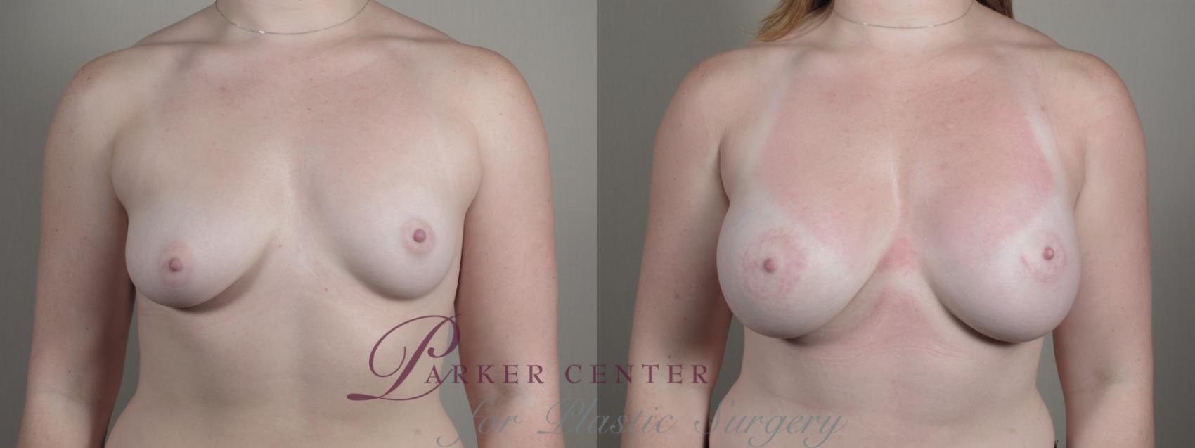 Breast Augmentation Case 1003 Before & After Front | Paramus, NJ | Parker Center for Plastic Surgery