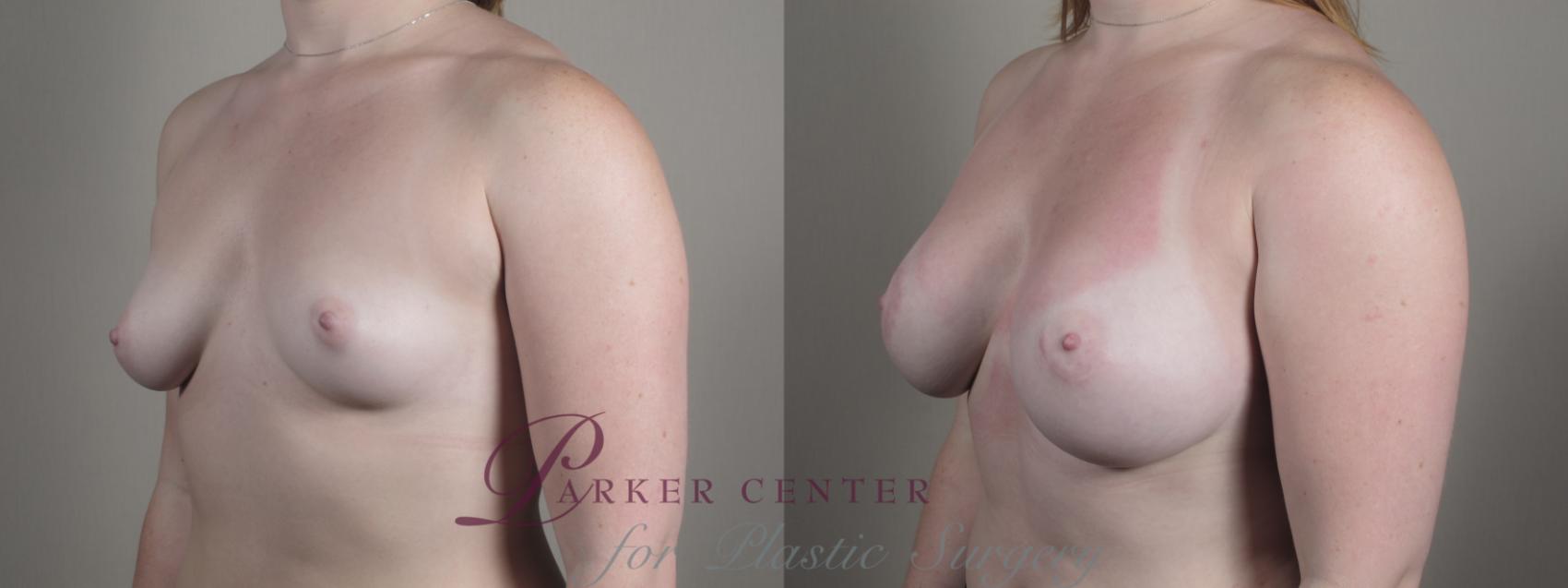 Breast Augmentation Case 1003 Before & After Right Oblique | Paramus, New Jersey | Parker Center for Plastic Surgery