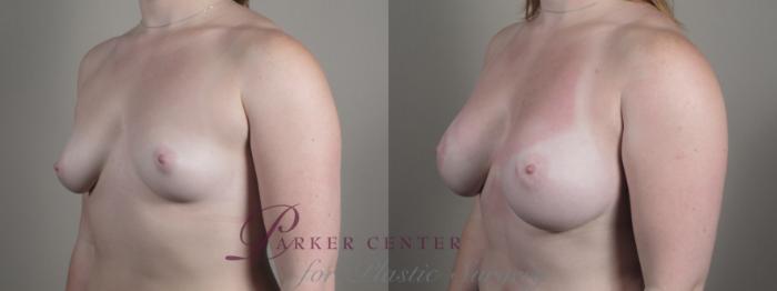 Breast Augmentation Case 1003 Before & After Right Oblique | Paramus, NJ | Parker Center for Plastic Surgery