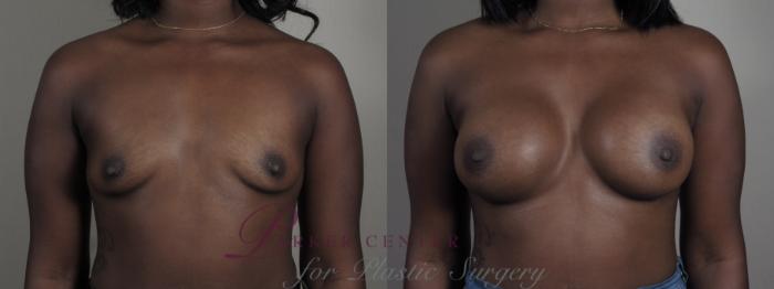Breast Augmentation Case 1007 Before & After Front | Paramus, NJ | Parker Center for Plastic Surgery