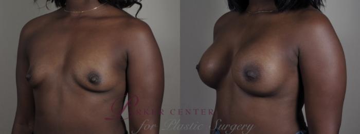Breast Augmentation Case 1007 Before & After Right Oblique | Paramus, NJ | Parker Center for Plastic Surgery