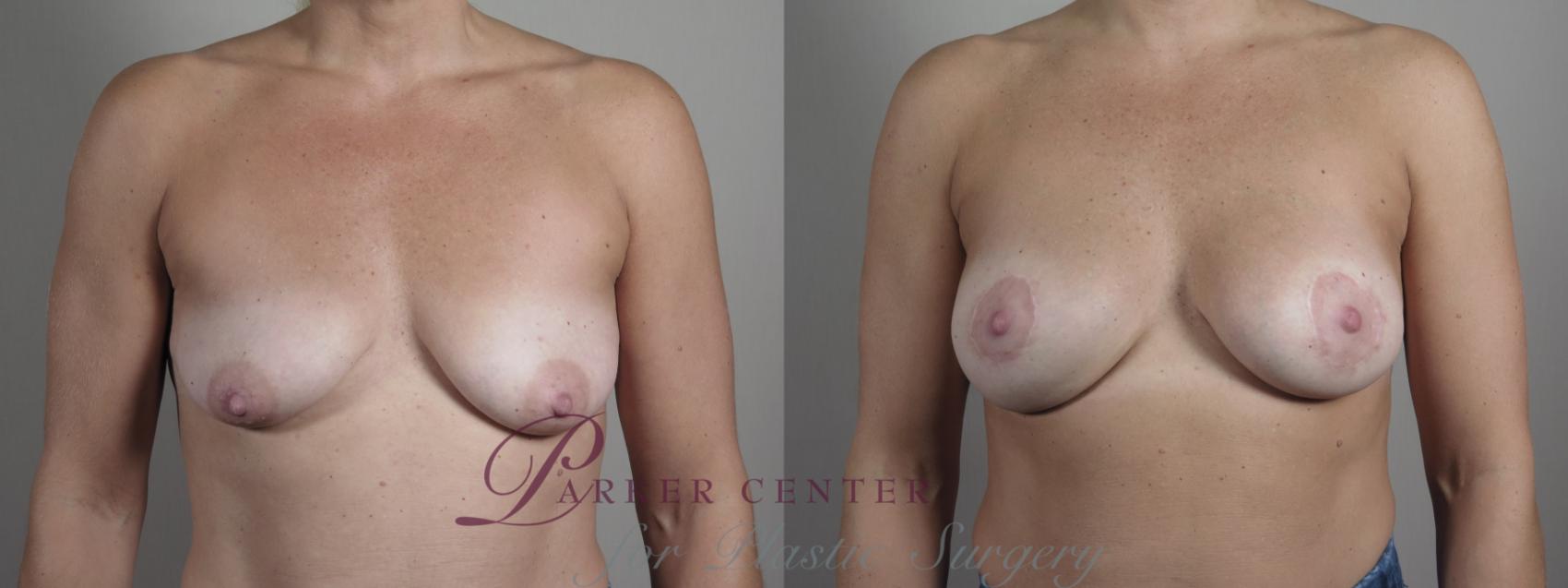 Breast Asymmetry Case 1022 Before & After Front | Paramus, NJ | Parker Center for Plastic Surgery