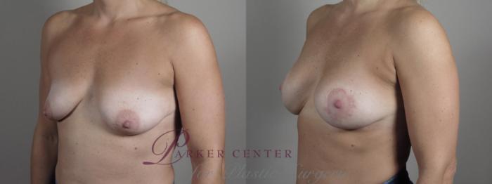 Breast Augmentation Case 1022 Before & After Right Oblique | Paramus, NJ | Parker Center for Plastic Surgery