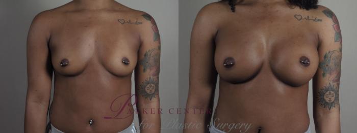 Breast Augmentation Case 1200 Before & After View #1  | Paramus, NJ | Parker Center for Plastic Surgery