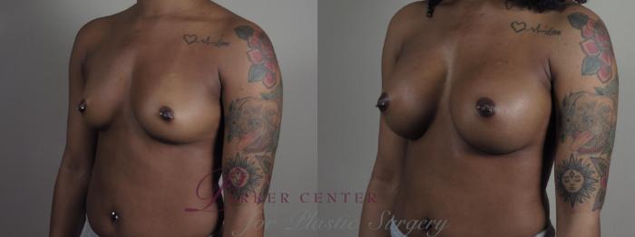 Breast Augmentation Case 1200 Before & After View #2 | Paramus, NJ | Parker Center for Plastic Surgery