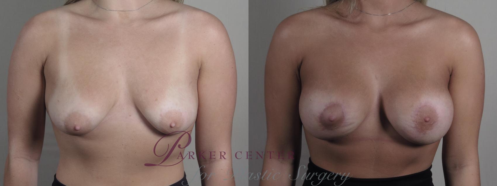 Breast Augmentation Case 1272 Before & After Front | Paramus, NJ | Parker Center for Plastic Surgery