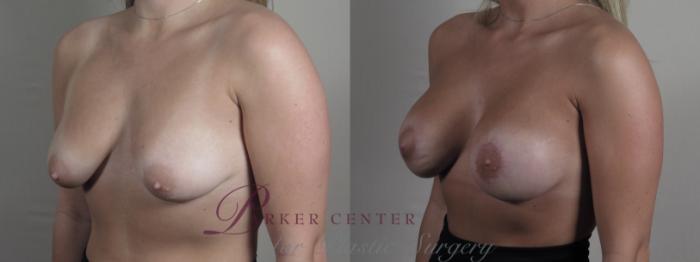Breast Augmentation Case 1272 Before & After Left Oblique | Paramus, NJ | Parker Center for Plastic Surgery