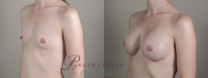 Breast Augmentation Case 1357 Before & After pre op post op | Paramus, New Jersey | Parker Center for Plastic Surgery