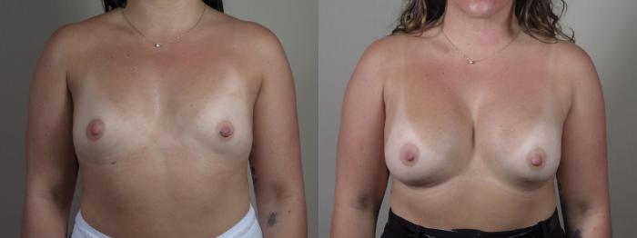 Breast Augmentation Case 1425 Before & After Front | Paramus, New Jersey | Parker Center for Plastic Surgery