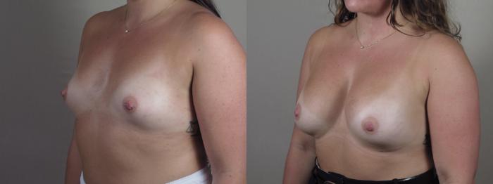 Breast Augmentation Case 1425 Before & After Side view | Paramus, New Jersey | Parker Center for Plastic Surgery