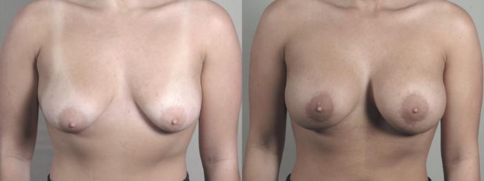 Breast Augmentation Case 1469 Before & After Front | Paramus, New Jersey | Parker Center for Plastic Surgery