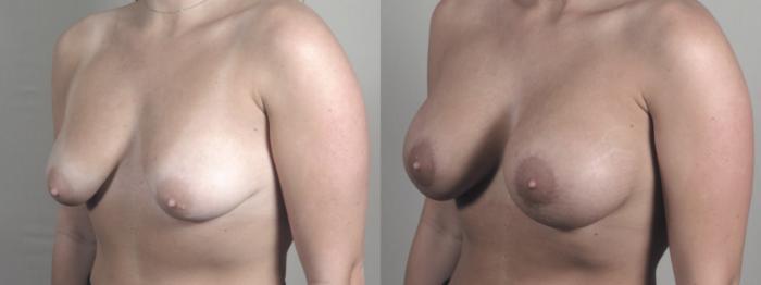 Breast Augmentation Case 1469 Before & After Left Oblique | Paramus, New Jersey | Parker Center for Plastic Surgery