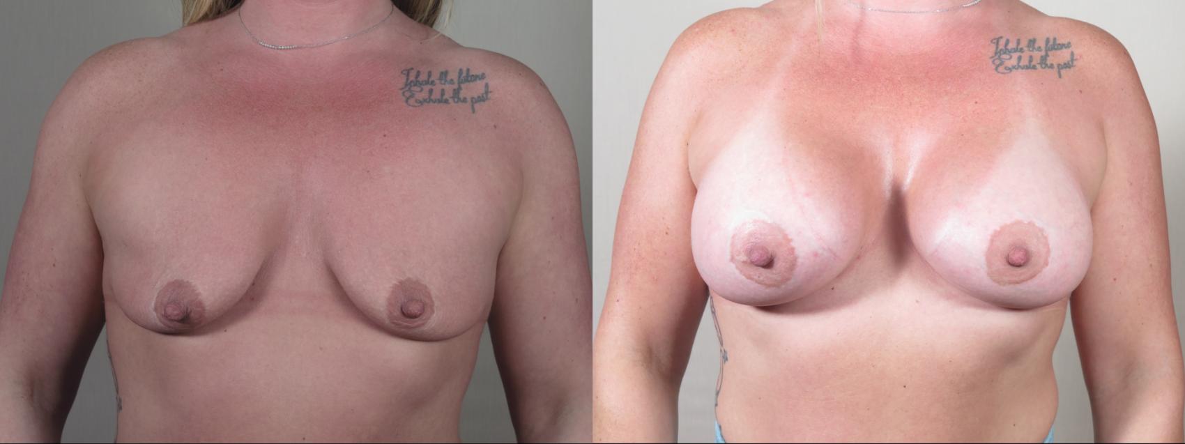 Breast Augmentation Case 1513 Before & After Front | Paramus, New Jersey | Parker Center for Plastic Surgery