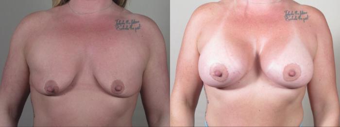 Breast Augmentation Case 1513 Before & After Front | Paramus, New Jersey | Parker Center for Plastic Surgery