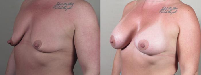 Breast Augmentation Case 1513 Before & After Left Oblique | Paramus, New Jersey | Parker Center for Plastic Surgery