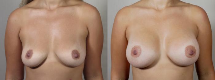 Breast Augmentation Case 1575 Before & After Front | Paramus, New Jersey | Parker Center for Plastic Surgery