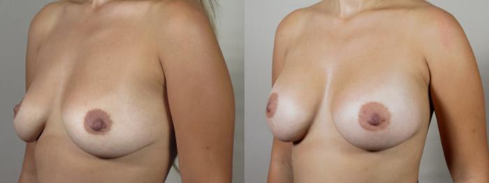 Breast Augmentation Case 1575 Before & After Left Oblique | Paramus, New Jersey | Parker Center for Plastic Surgery
