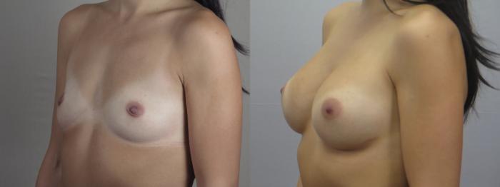Breast Augmentation Case 1576 Before & After Left Oblique | Paramus, New Jersey | Parker Center for Plastic Surgery