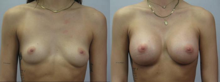 Breast Augmentation Case 1577 Before & After Front | Paramus, New Jersey | Parker Center for Plastic Surgery